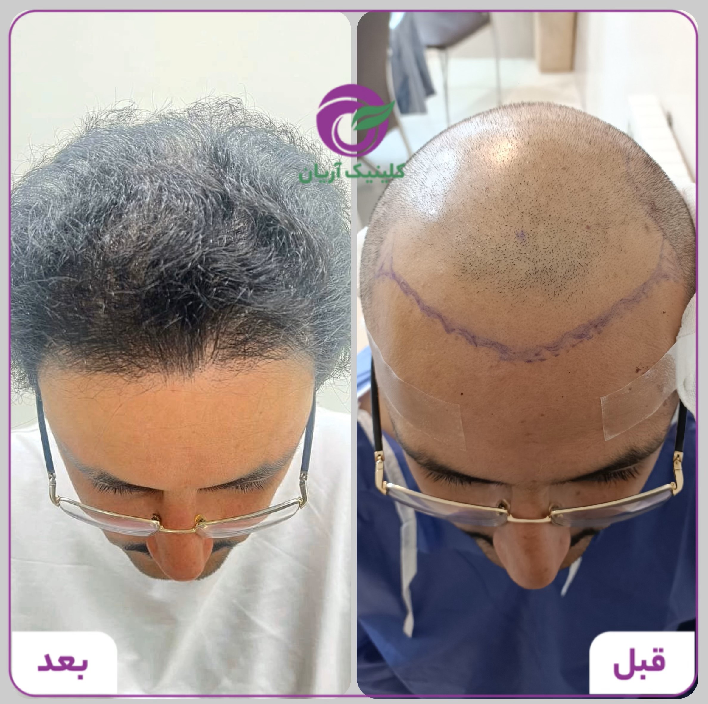 گالری کاشت مو 